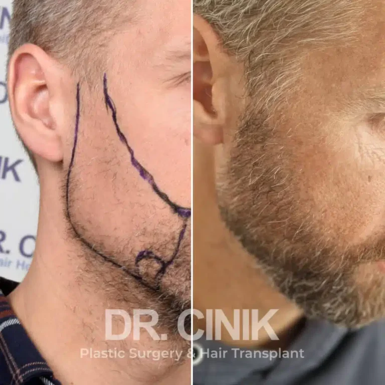 Greffe de barbe avant-après : 3100 greffons