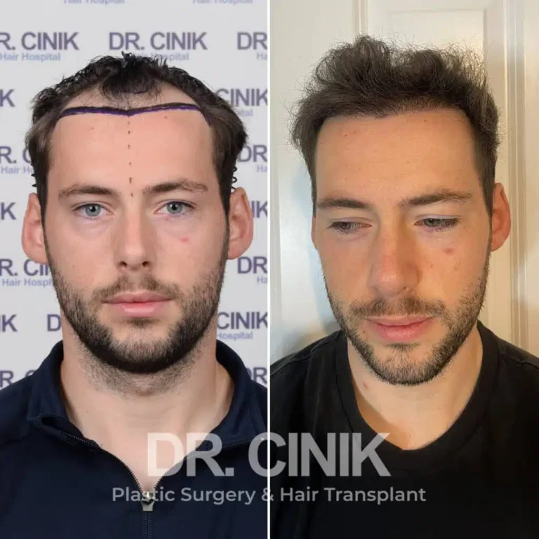 Greffe de cheveux DHI avant-après : 2600 greffons