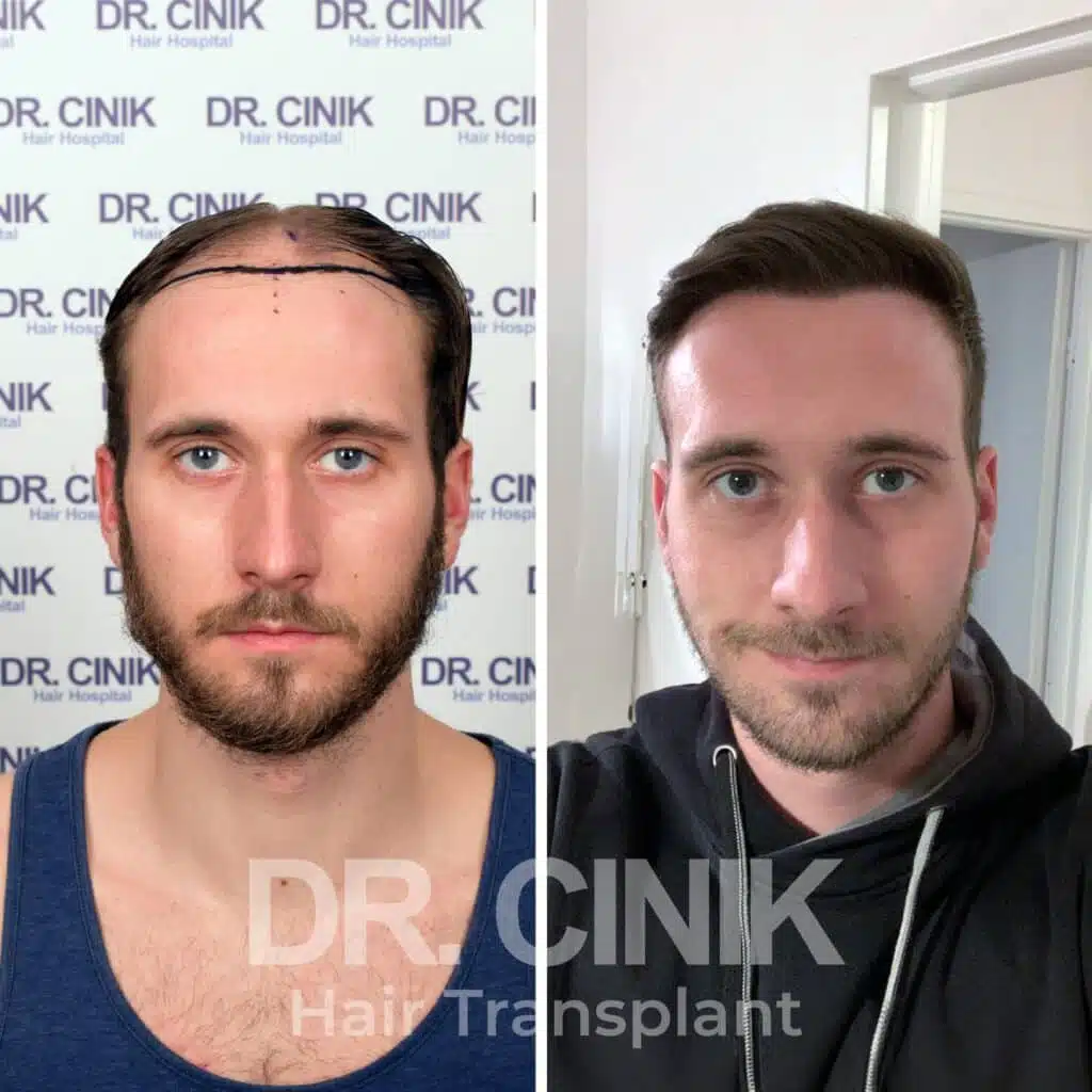 Greffe de cheveux FUE avant-après : 5000 greffons