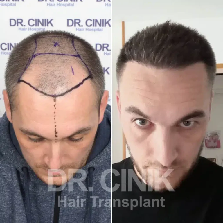 Greffe de cheveux FUE Saphir avant-après : 3800 greffons