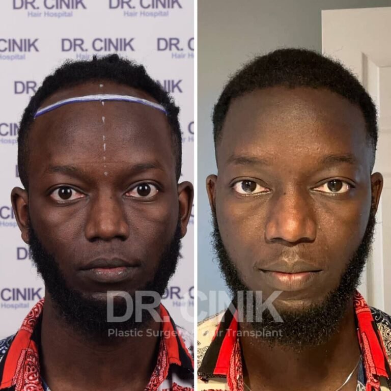 Greffe de cheveux afro avant-après : 3000 greffons