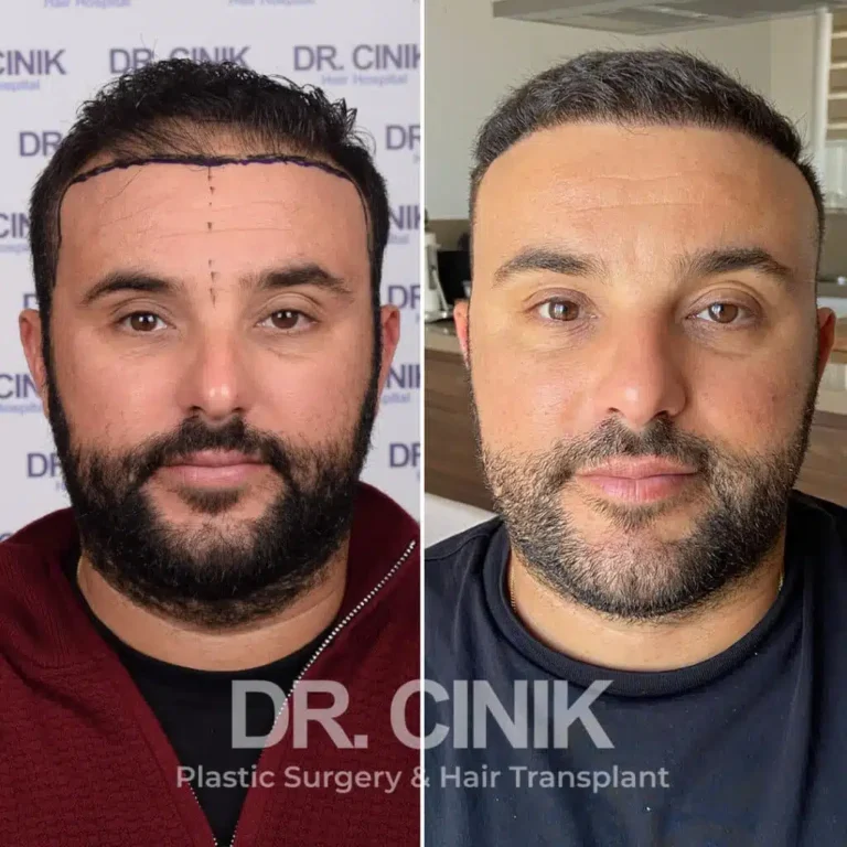 Greffe de cheveux DHI avant-après : 3400 greffons