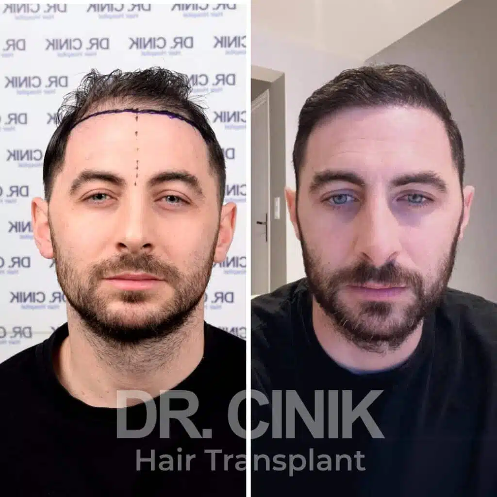 Greffe de cheveux FUE avant-après : 4450 greffons