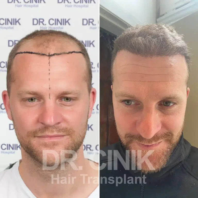 Greffe de cheveux FUE Saphir avant-après : 3950 greffons