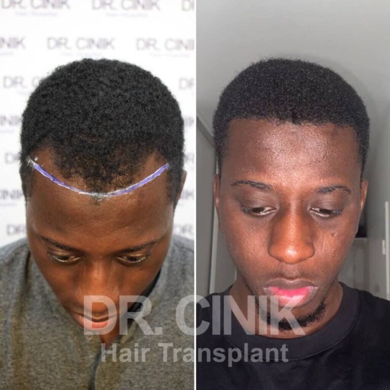 Greffe de cheveux afro avant-après : 3050 greffons