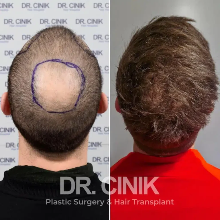 Greffe de cheveux DHI avant-après : 3000 greffons