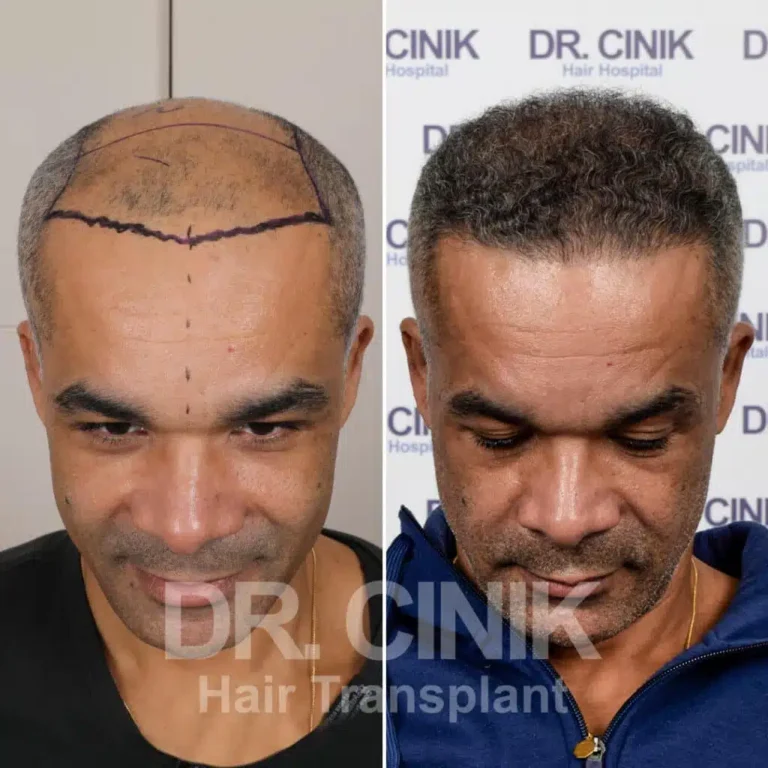 Greffe de cheveux FUE Saphir avant-après : 4600 greffons