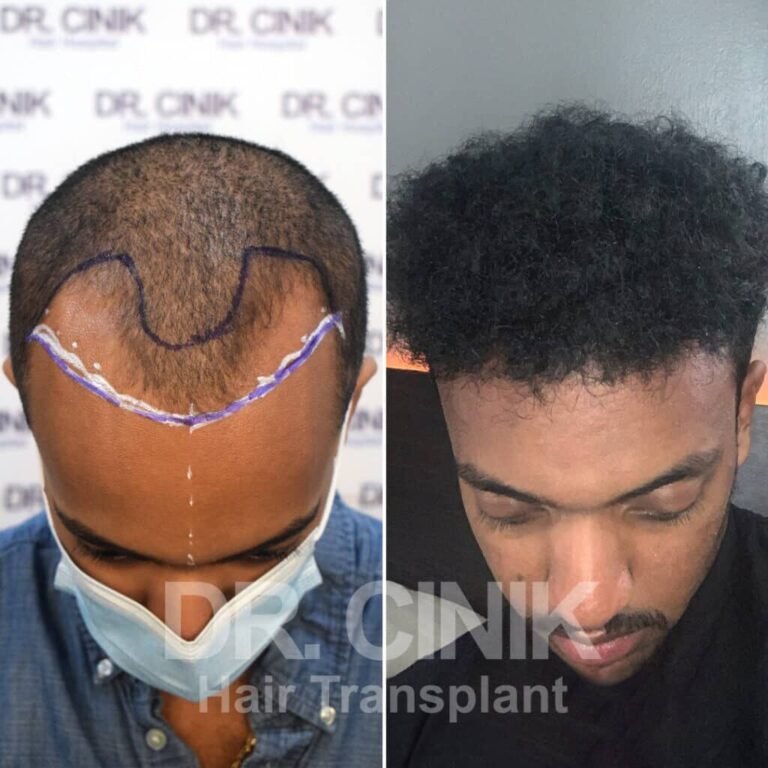 Greffe de cheveux afro avant-après : 3800 greffons