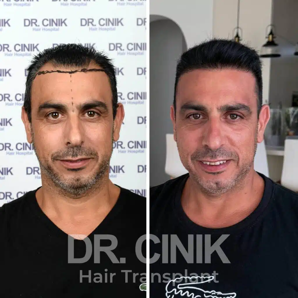 Greffe de cheveux FUE avant-après : 3700 greffons