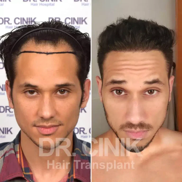 Greffe de cheveux FUE Saphir avant-après : 3280 greffons