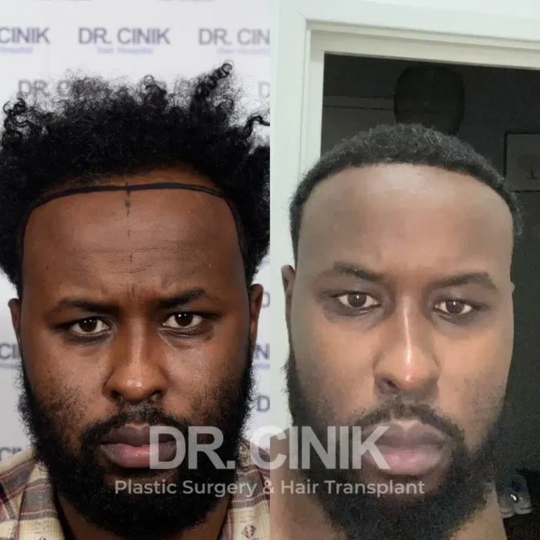 Greffe de cheveux afro avant-après : 3450 greffons