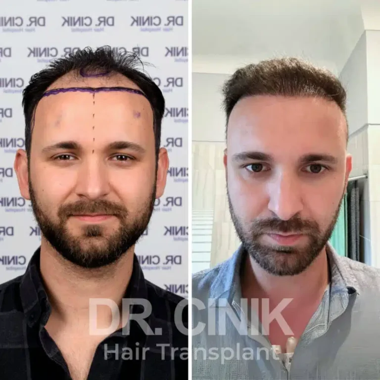 Greffe de cheveux DHI avant-après : 4000 greffons