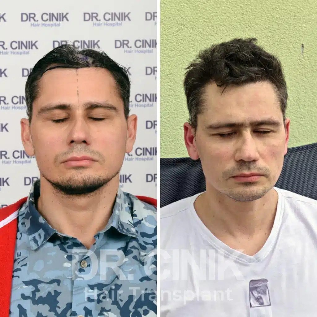 Greffe de cheveux FUE avant-après : 3500 greffons