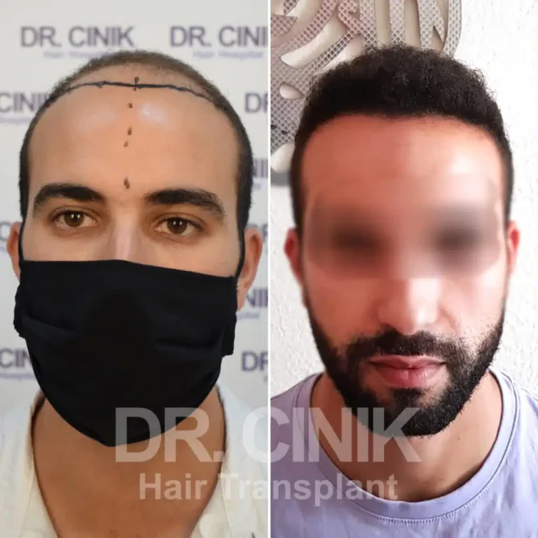 Greffe de cheveux FUE Saphir avant-après : 4400 greffons