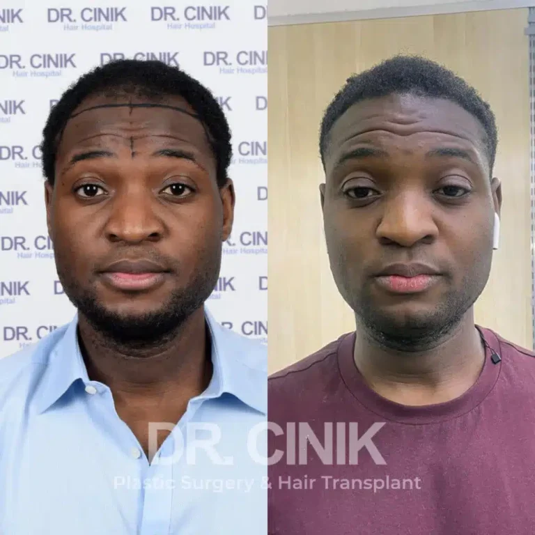 Greffe de cheveux afro avant-après : 3000 greffons