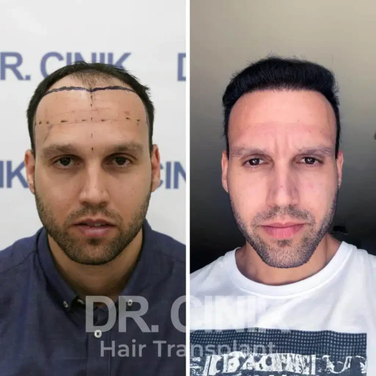 Greffe de cheveux DHI avant-après : 4250 greffons