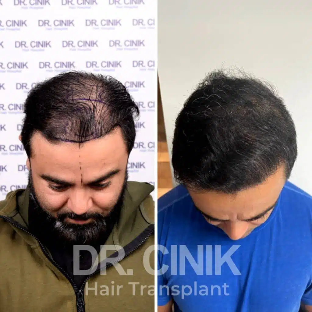 Greffe de cheveux FUE avant-après : 4300 greffons