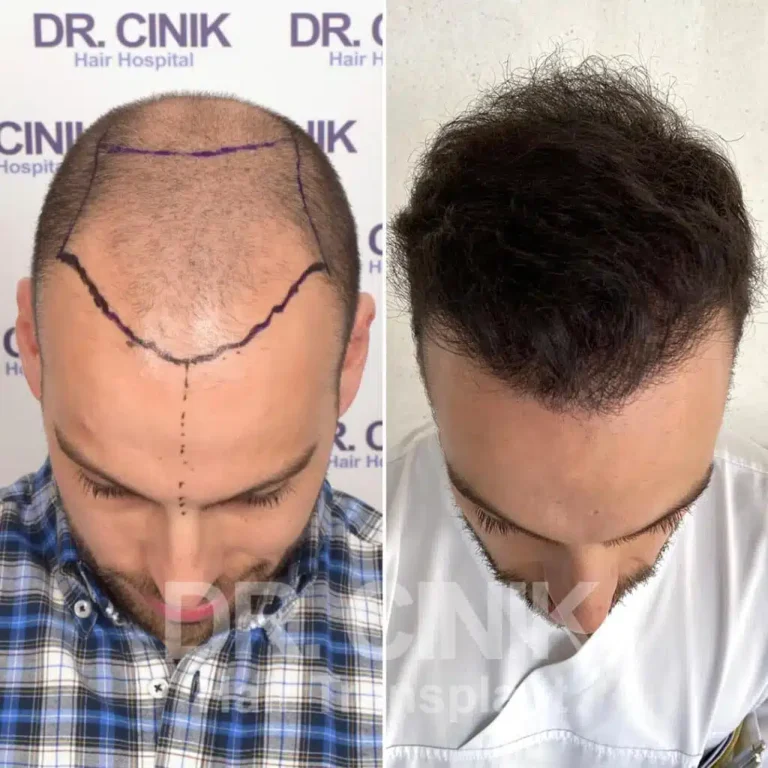 Greffe de cheveux FUE Saphir avant-après : 4000 greffons