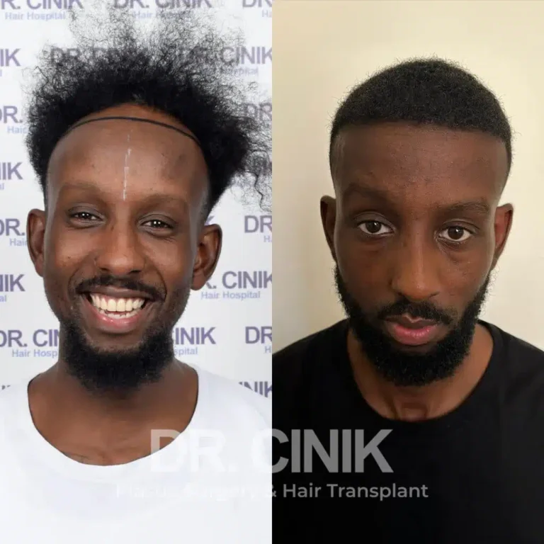 Greffe de cheveux afro avant-après : 3600 greffons