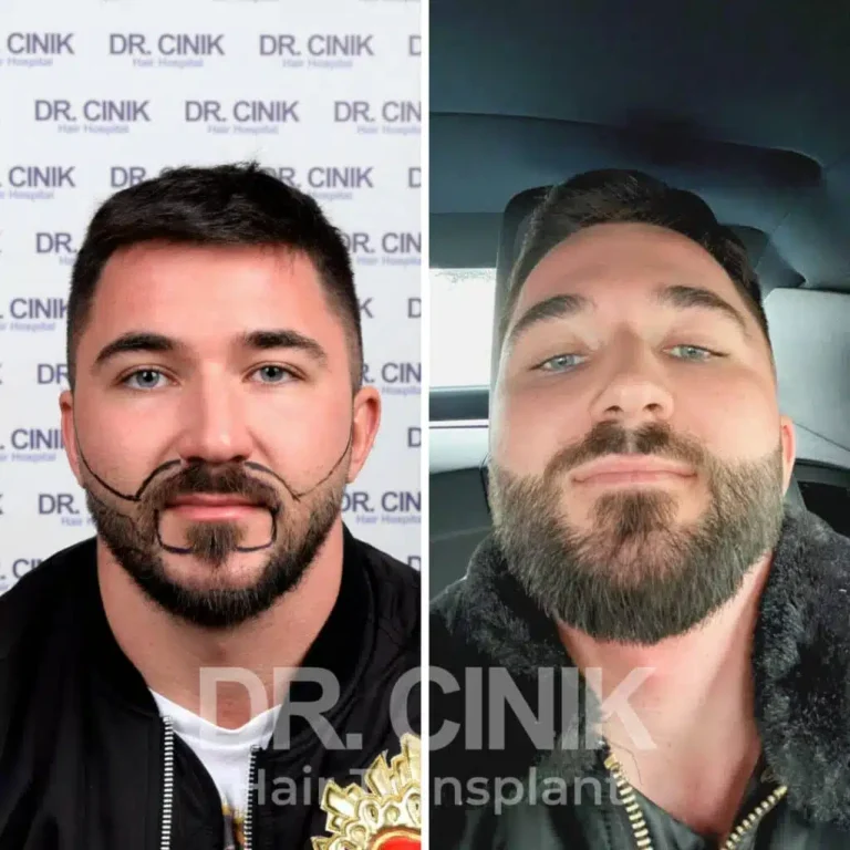 Greffe de cheveux DHI avant-après : 2400 greffons