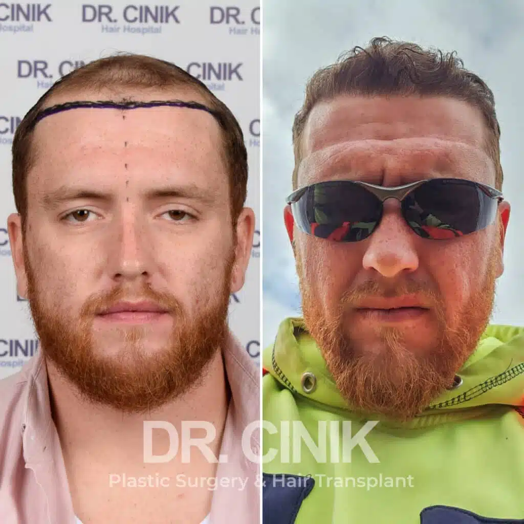 Greffe de cheveux FUE avant-après : 3900 greffons