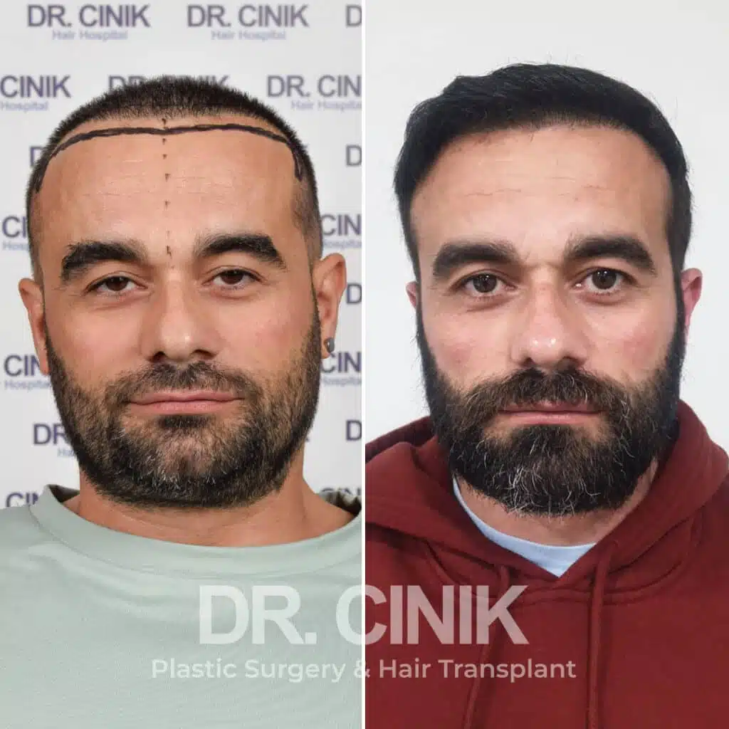 Greffe de cheveux FUE avant-après : 3500 greffons