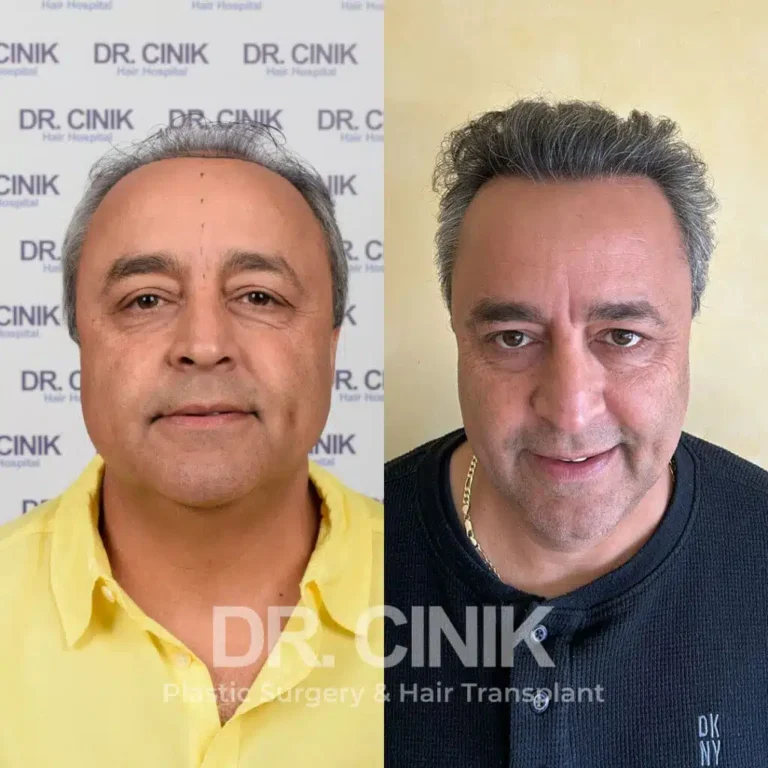 Greffe de cheveux FUE Saphir avant-après : 3800 greffons