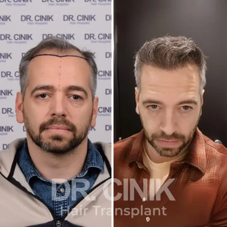 Greffe de cheveux DHI avant-après : 4780 greffons