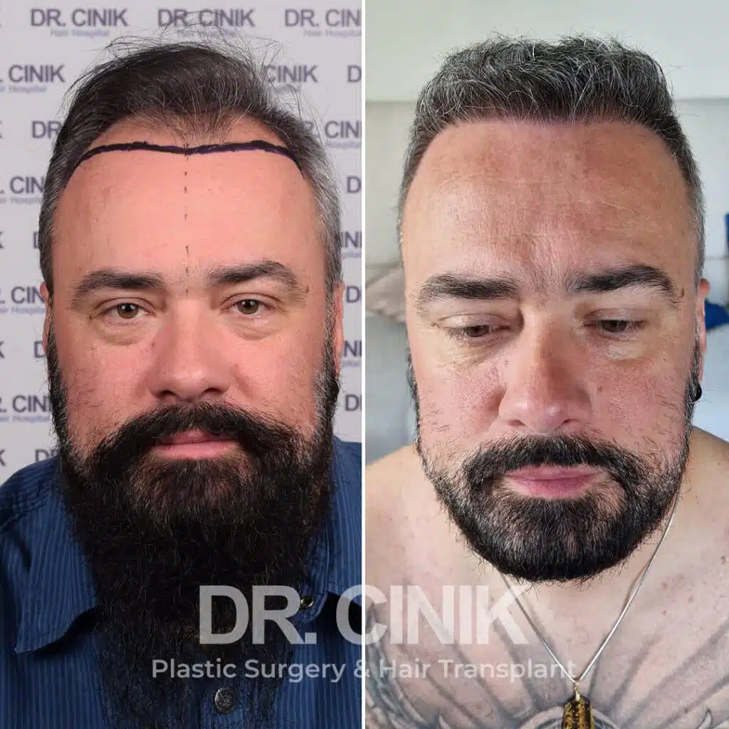 Greffe de cheveux FUE avant-après : 3000 greffons