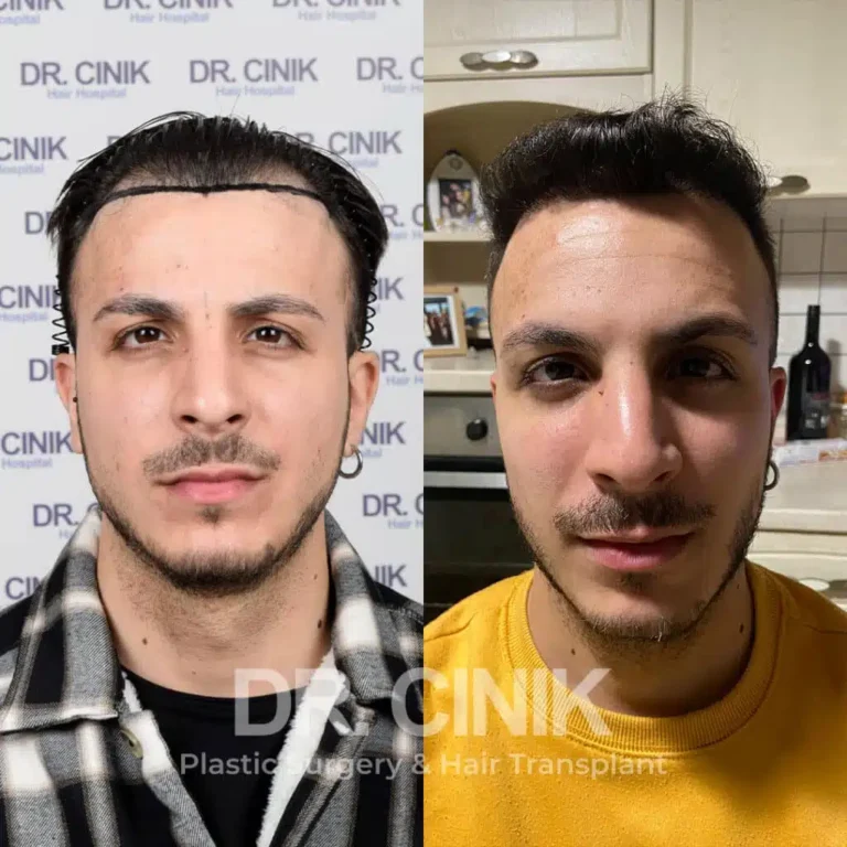 Greffe de cheveux FUE Saphir avant-après : 3500 greffons