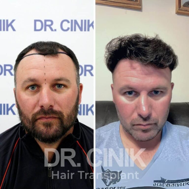 Greffe de cheveux DHI avant-après : 4400 greffons