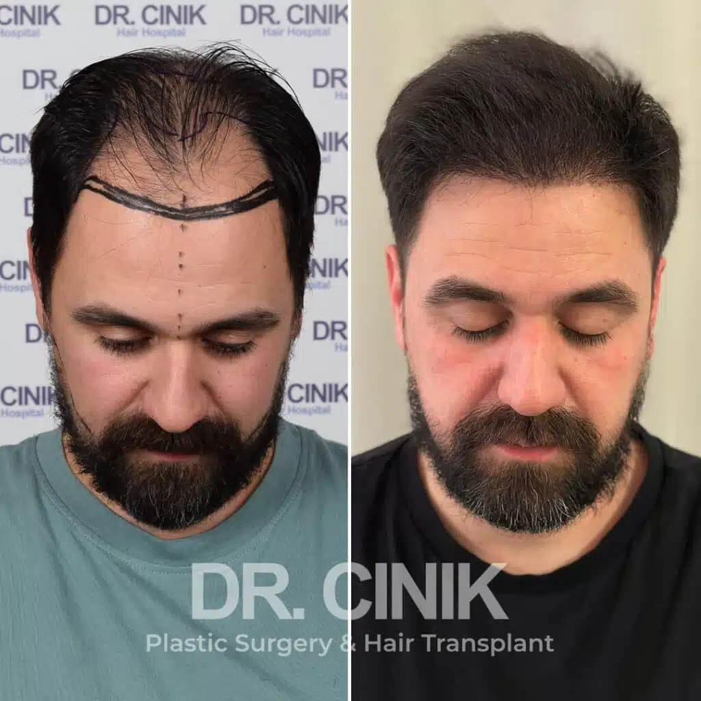 Greffe de cheveux FUE avant-après : 4500 greffons