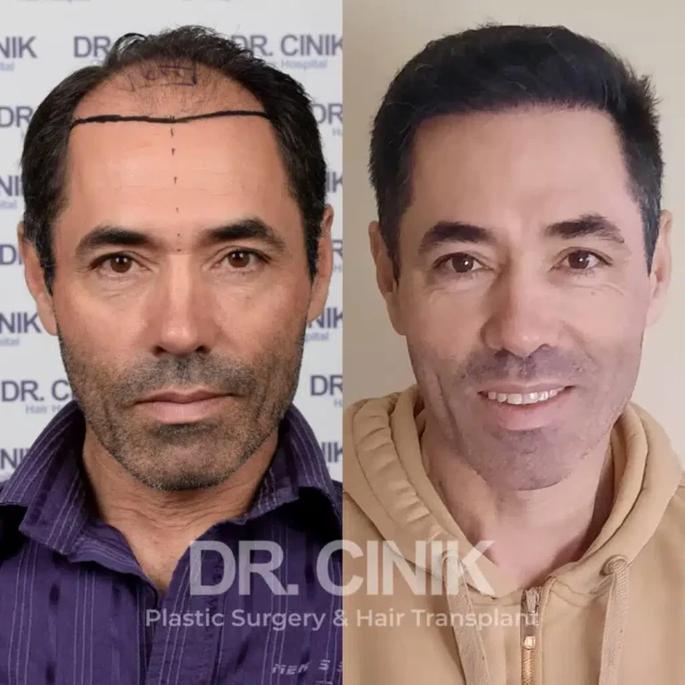 Greffe de cheveux FUE Saphir avant-après : 4600 greffons