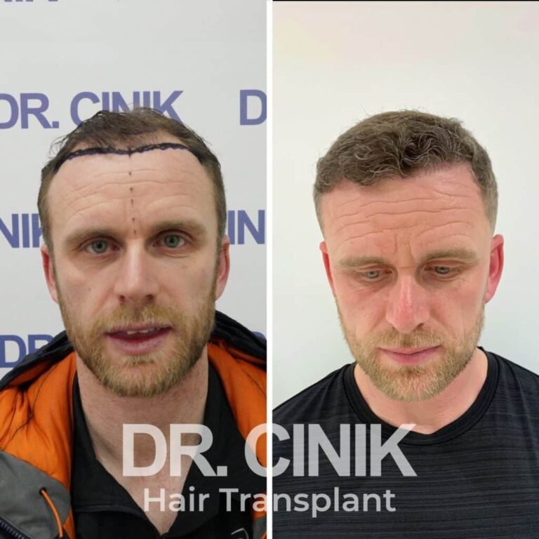 Greffe de cheveux DHI avant-après : 4750 greffons