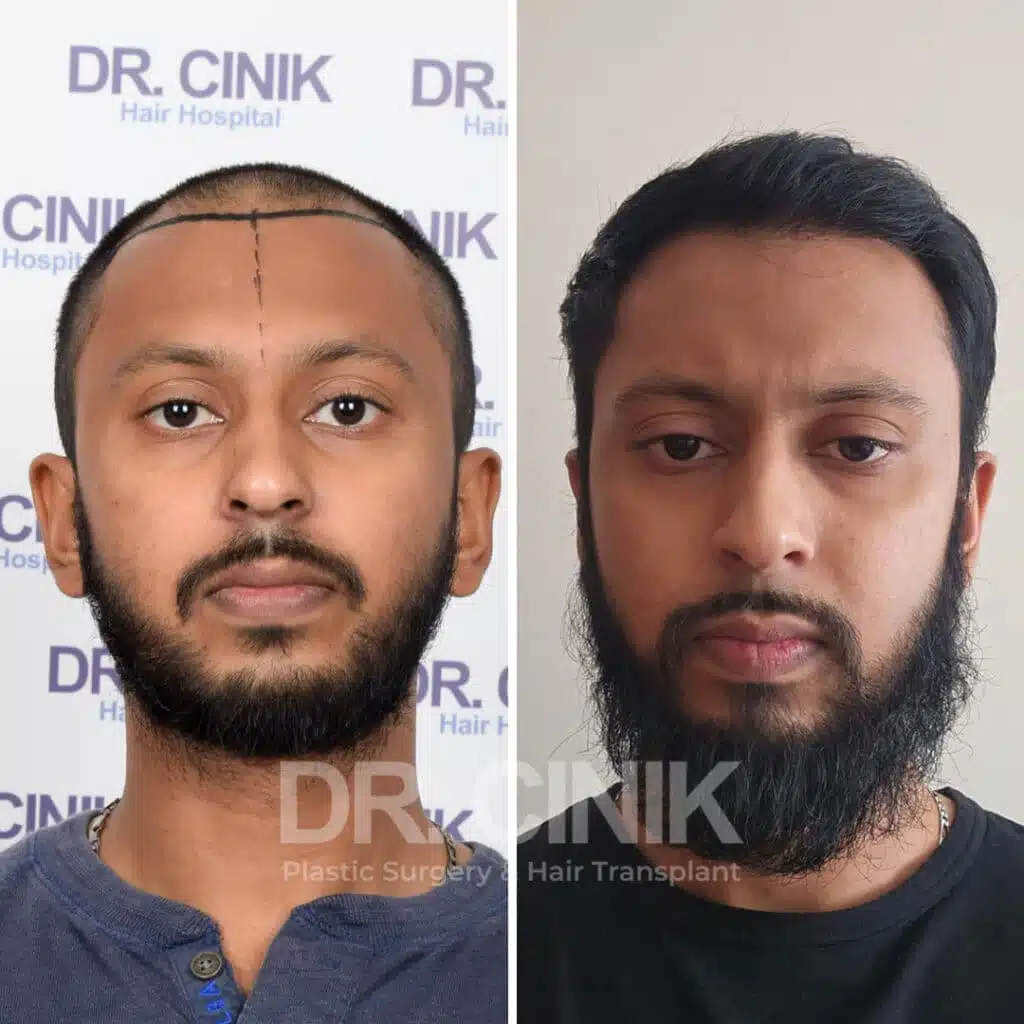 Greffe de cheveux FUE avant-après : 4150 greffons