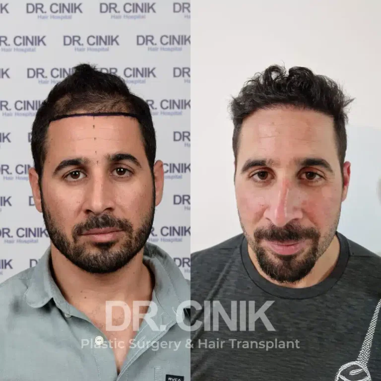 Greffe de cheveux FUE Saphir avant-après : 3100 greffons