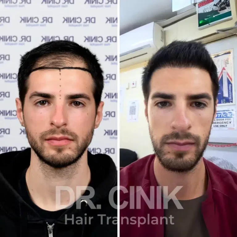 Greffe de cheveux DHI avant-après : 3100 greffons