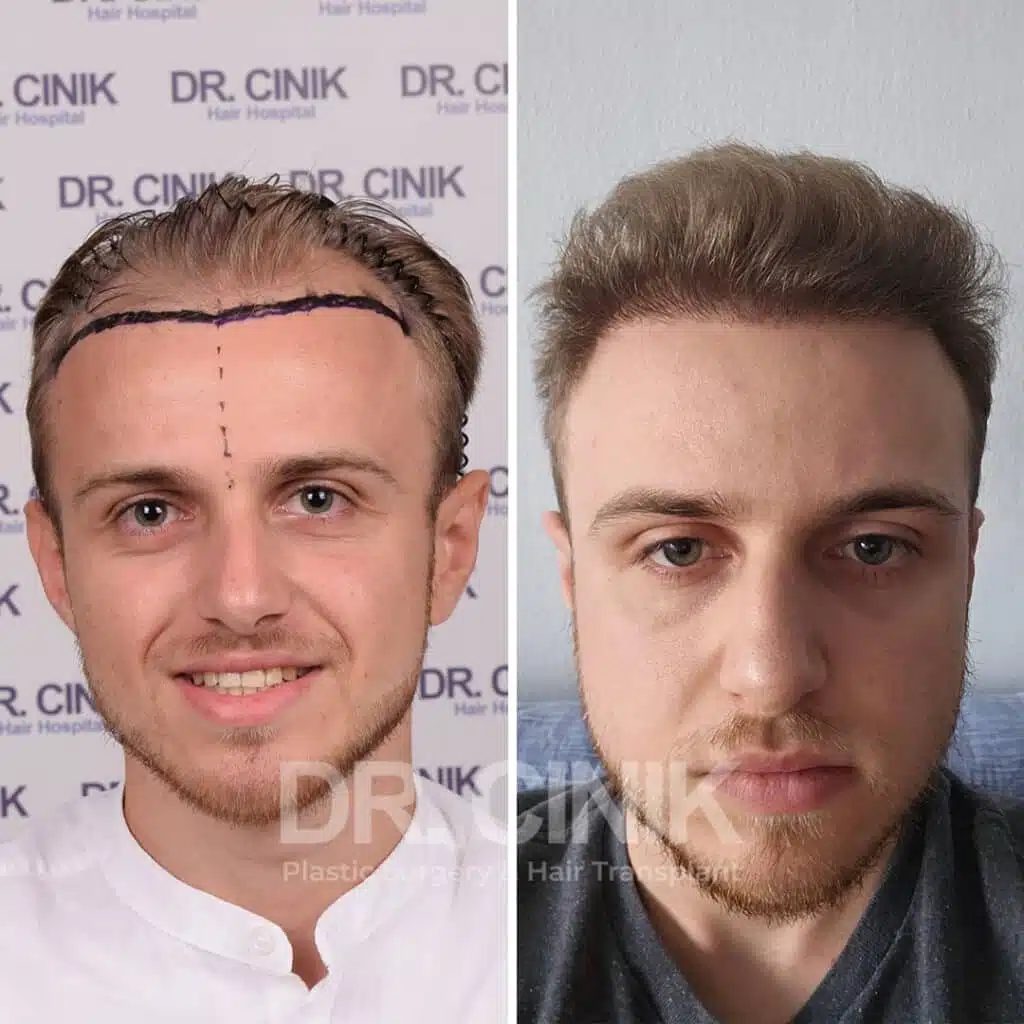 Greffe de cheveux FUE avant-après : 4200 greffons