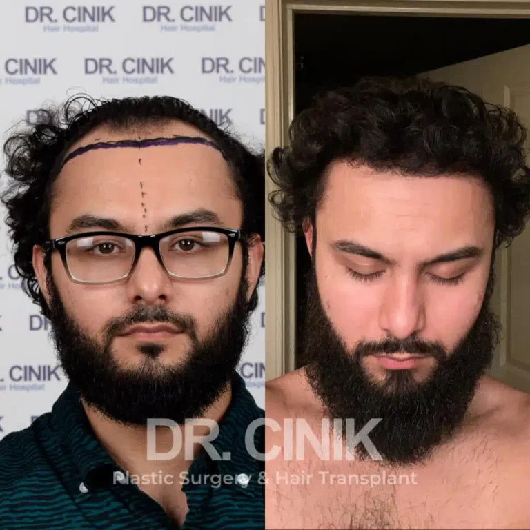 Greffe de cheveux FUE Saphir avant-après : 3000 greffons