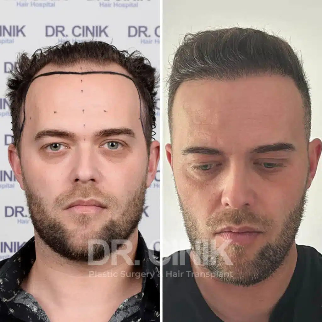 Greffe de cheveux FUE avant-après : 4000 greffons