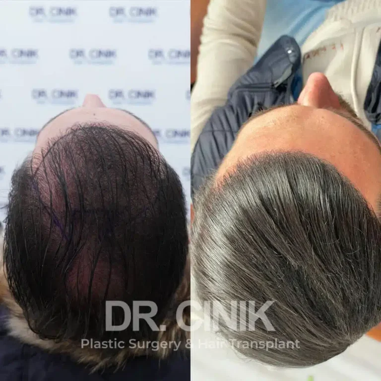 Greffe de cheveux FUE Saphir avant-après : 4000 greffons