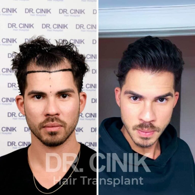 Greffe de cheveux DHI avant-après : 3850 greffons