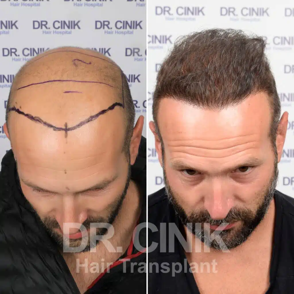 Greffe de cheveux FUE avant-après : 3900 greffons