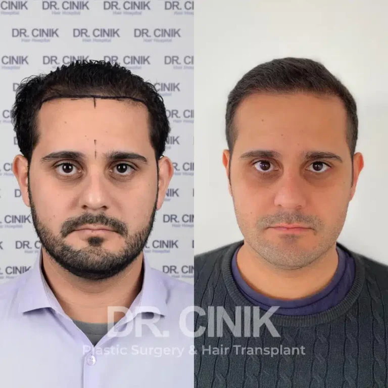 Greffe de cheveux FUE Saphir avant-après : 4200 greffons