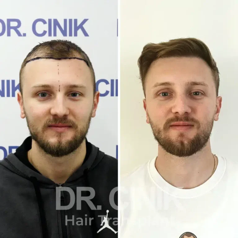 Greffe de cheveux DHI avant-après : 2500 greffons