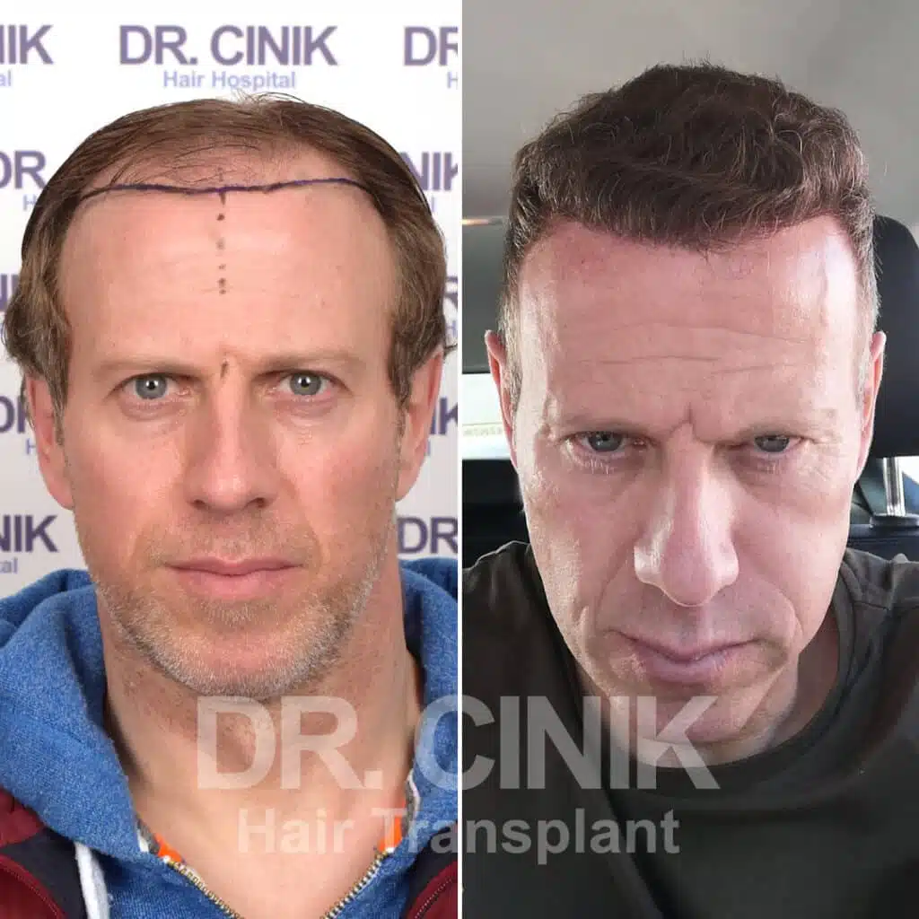 Greffe de cheveux FUE avant-après : 4400 greffons