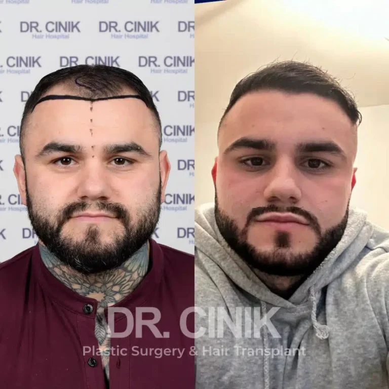 Greffe de cheveux FUE Saphir avant-après : 3600 greffons