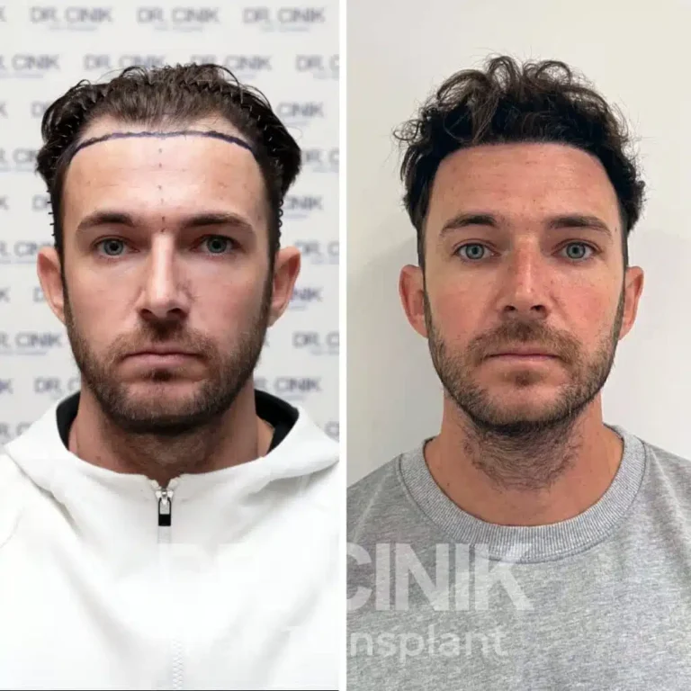 Greffe de cheveux DHI avant-après : 3400 greffons