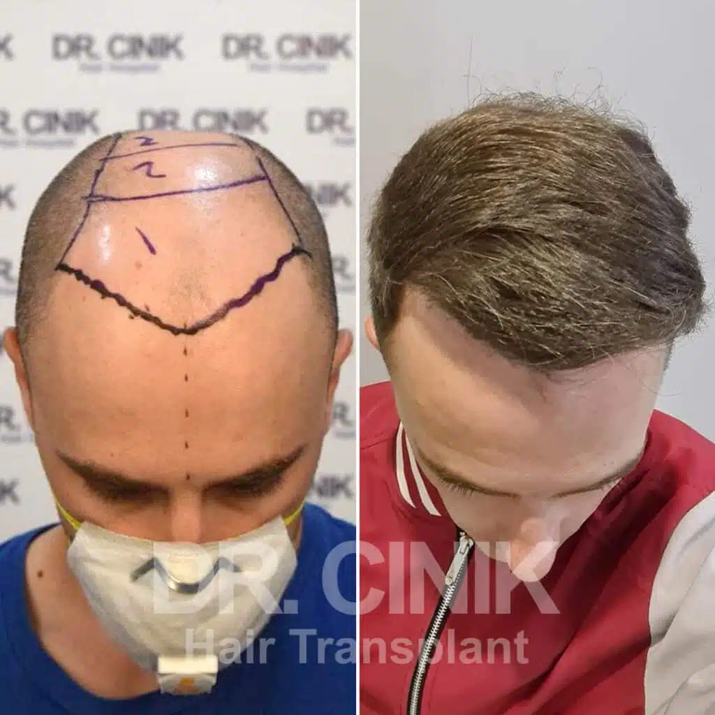 Greffe de cheveux FUE avant-après : 4600 greffons