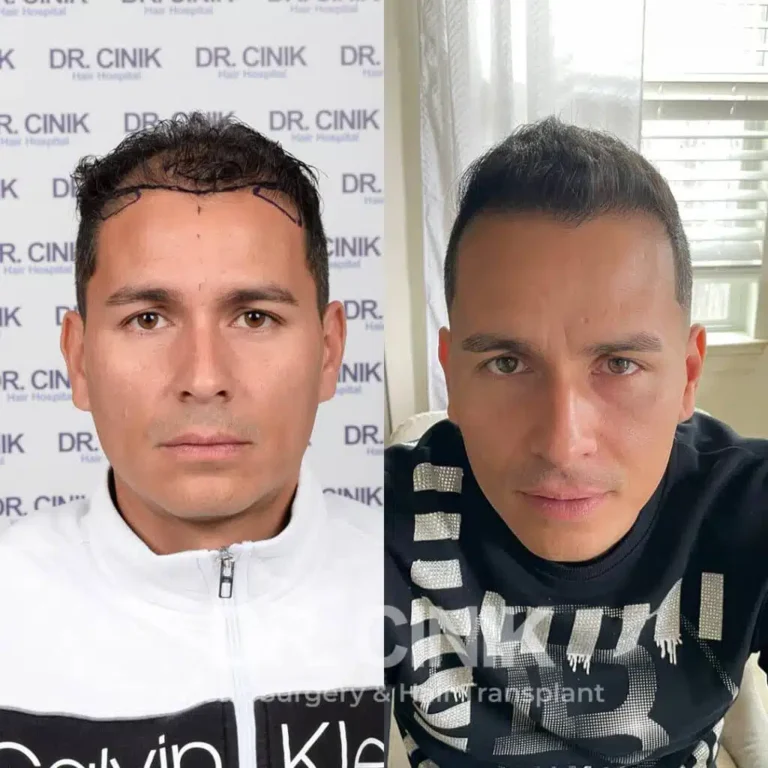 Greffe de cheveux FUE Saphir avant-après : 3600 greffons